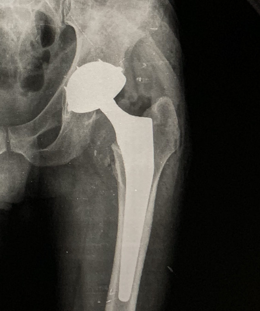 Radiografia de quadril com pós cirurgia de ATQ. O paciente recupera a mobilidade e a qualidade de vida (sem dor) quando a cirurgia é bem indicada e executada. 