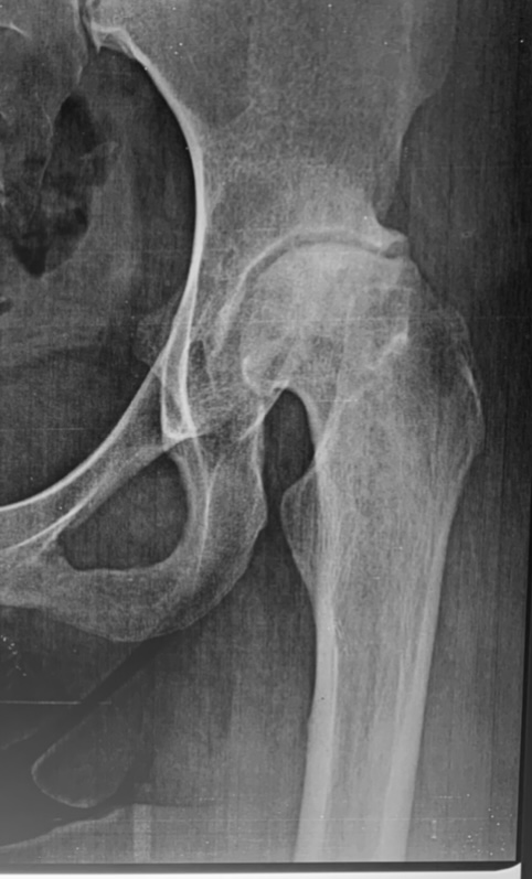 Radiografia de quadril de um adulto jovem com artrose por sequela de doença da infância.