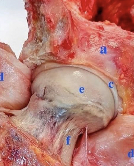 Peça anatômica com cabeça femoral (e) apresentado esfericidade e cartilagem em bom estado (sem artrose). 