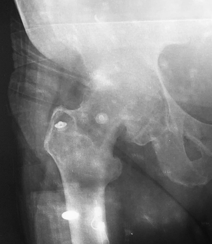 Radiografia com artrose grave de quadril. Observa-se obliteração do espaço articular e formação de grandes osteófitos. Este paciente não tinha mobilidade do quadril.