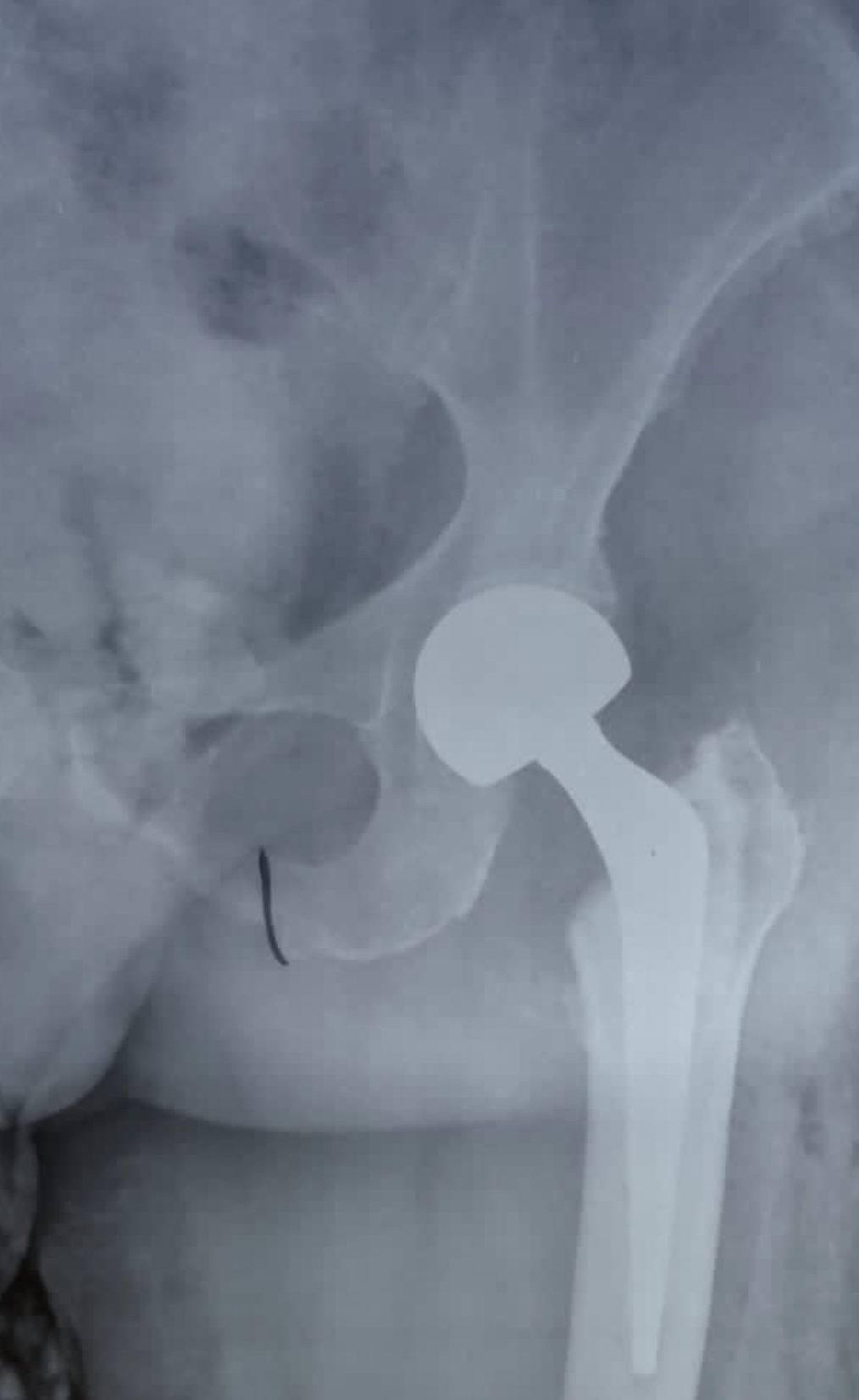 Radiografia de quadril com prótese parcial de quadril. Cirurgia mais comum em pacientes com fratura do colo do fêmur e baixa expectativa de vida.