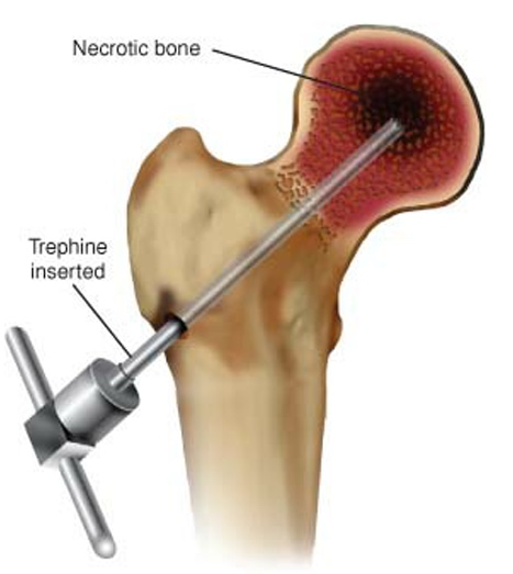 A descompressão do núcleo necrótico é a cirurgia mais comum em paciente com estágios iniciais, dor e edema ósseo. É uma cirurgia percutânea (minimamente invasiva).