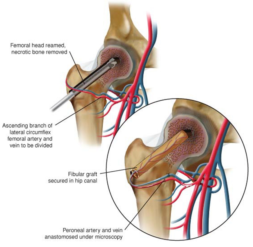 Enxerto vascularizado é um tratamento incomum por diversos motivos.